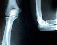 Worm 'superglue' may bind human joints