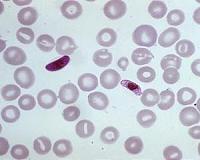 Warmer climate threatens malaria spread in Ethiopia